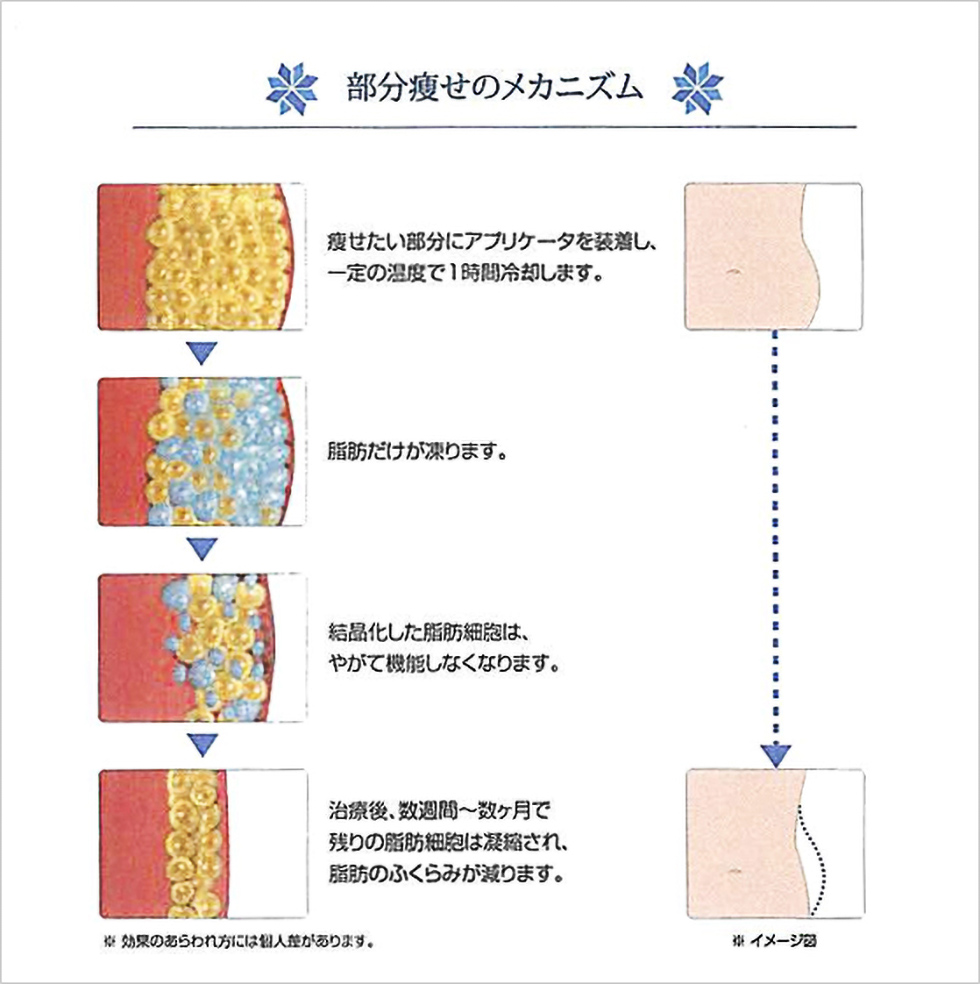 クール・スカルプティングで痩せる仕組み